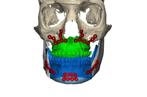 Rendering 3D di chirurgia maxillo-facciale con protesi prodotta mediante stampa 3D