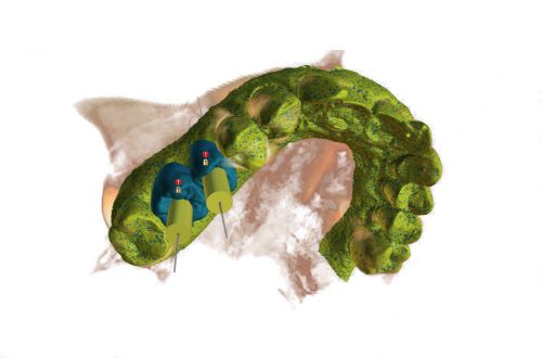 Rendering 3D di odontoiatria con protesi prodotta mediante stampa 3D